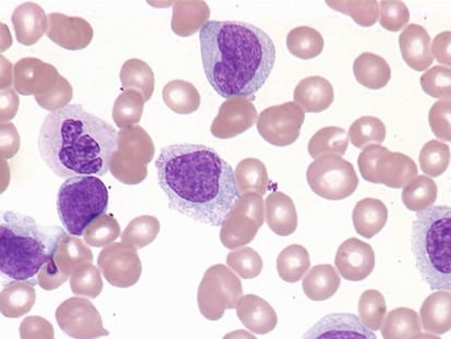 Muestra de células de una persona con leucemia mielocítica aguda.