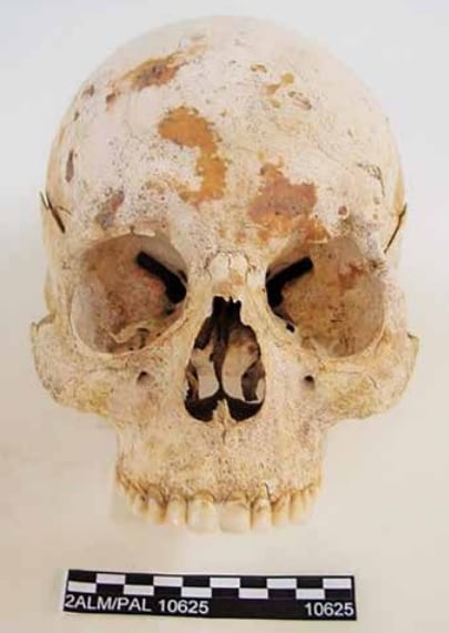 Hombre de entre 25 y 30 años con apertura nasal redondeada, síntoma de sífilis, lepra o tuberculosis.