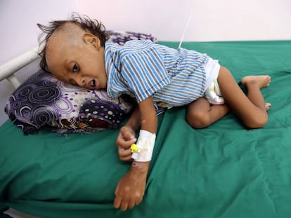El niño Jibril Mohammed Ali Al Hakami, hospitalizado por malnutrición en un hospital de Hodeida, en una imagen tomada el pasado sábado.