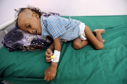 El niño Jibril Mohammed Ali Al Hakami, hospitalizado por malnutrición en un hospital de Hodeida, en una imagen tomada el pasado sábado.