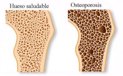 El consumo de estas bebidas puede aumentar tus probabilidades de sufrir osteoporosis