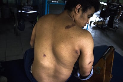 Una víctima civil muestra doce impactos de bala. Uno de ellos le secciono la médula espinal y lo dejó parapléjico. Actualmente recibe tratamiento en el Instituto Salvadoreño de Rehabilitación Integral, en San Salvador.