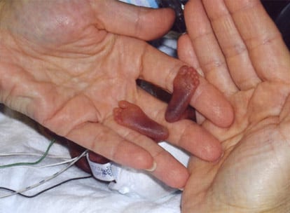 El nacimiento en 2006 de Amillia Taylor en Miami, con menos de 22 semanas de embarazo, fue un <i>milagro</i> del avance de la medicina.