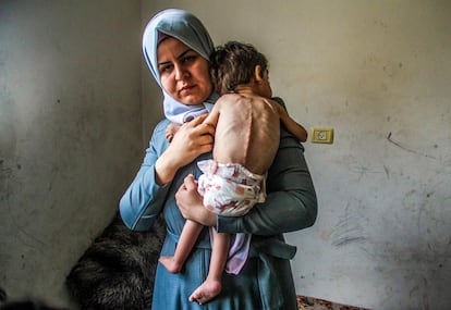 Amjad Al-Qanoo, un niño palestino de 3 años con una salud muy deteriorada, lucha por sobrevivir debido a la desnutrición. Imagen realizada en el distrito de Jibaliya de la ciudad de Gaza, el 9 de Junio de 2024. Los niños y niñas palestinos que viven en la Franja de Gaza en medio de los ataques israelíes corren también un alto riesgo de morir por desnutrición y deshidratación.