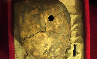 En el museo se exhibe este cráneo prehispánico. Sobre el agujero, se considera que pudo tratarse de un intento rudimentario de cirugía.