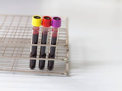 Mi hijo tiene 18 años y nunca le he hecho una analítica, ¿he actuado bien?