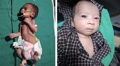 La niña a su llegada al hospital y hace unos días.