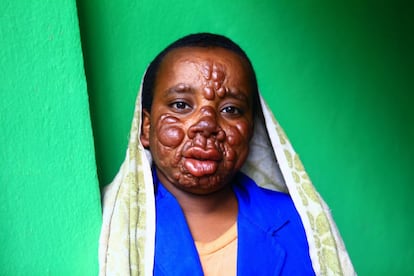 Endale Dajene, de 12 años, tiene el tipo de lepra más grave, que se caracteriza por provocar en la persona que la padece el aspecto que la literatura describe como "cara de león".