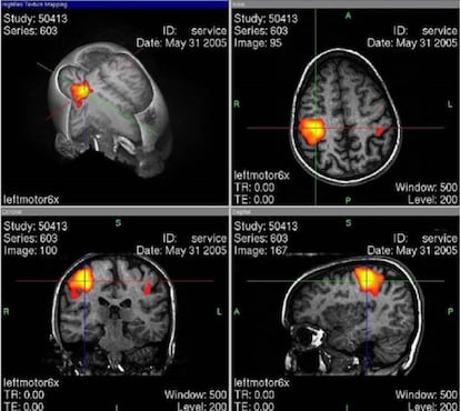 Una imagen por resonancia magnética funcional mide la cantidad de oxígeno consumido por las neuronas en zonas del cerebro de entre 2 y 8 milímetros cúbicos.