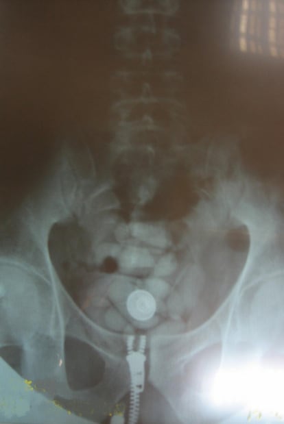 Radiografía de una persona detenida por el Grupo de Estupefacientes de Madrid-Barajas en la que se ven múltiples bolas de cocaína dentro de su vientre.
