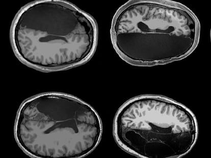 Imágenes de cerebros con la mitad extirpada. Firma: Caltech Brain Imaging Center


