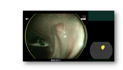 Detección de pólipos mediante la herramienta CAD-EYE, que utiliza soluciones de inteligencia artificial.