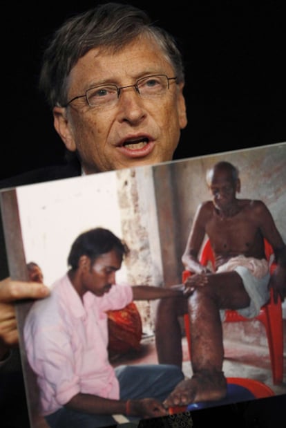 Bill Gates, con la foto de un caso de filariasis.