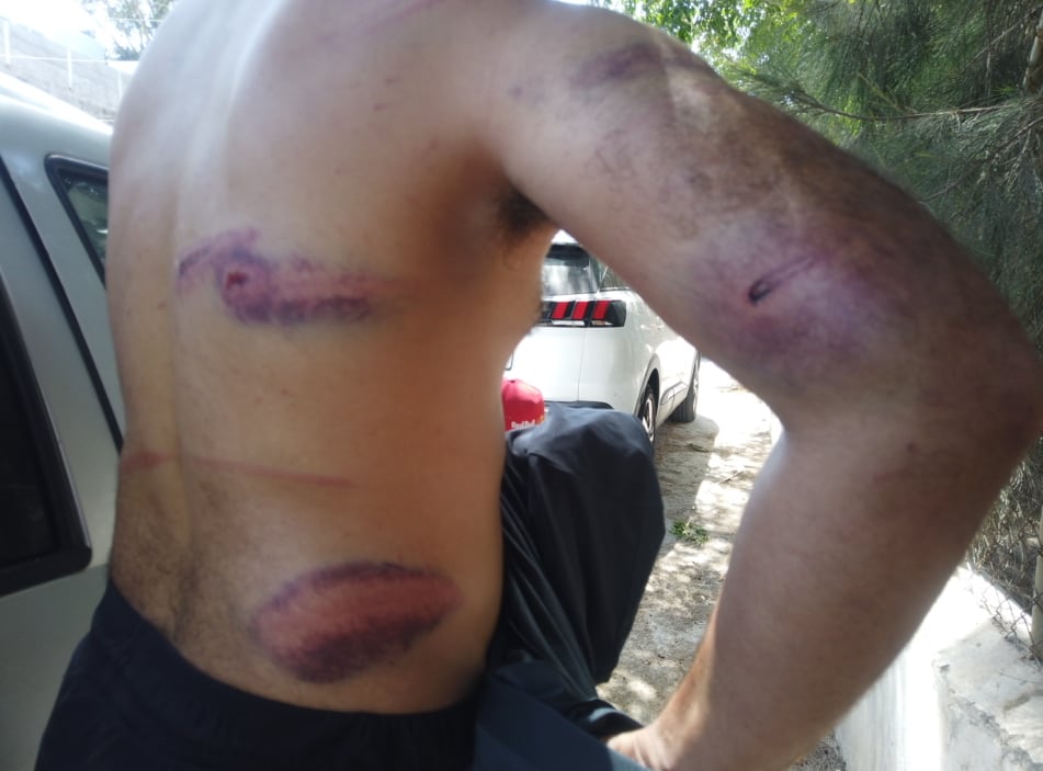 Un inmigrante muestra lesiones que asegura le causaron militares en Ceuta. 
