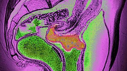 An MRI scan shows cervical cancer.
