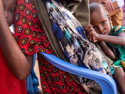 Un niño que sufre de desnutrición severa, en Somalia.