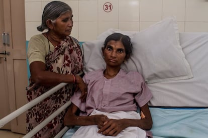 Chandravathi, de 35 años, acompañada por su madre en su cama del hospital de Bathalapalli. Tiene una tuberculosis meníngea que le ha dañado parte del cerebro e inmovilizado las piernas. Fue diagnosticada de VIH hace tres años, pero no tomó antirretrovirales. Con las defensas bajas, la bacteria de la tuberculosis no tuvo problema para instalarse en su famélico cuerpo, que hoy no supera los 25 kilos. Su futuro es incierto pues la tuberculosis es la causa principal de muerte de las personas infectadas por el VIH: en 2015, provocó una de cada tres defunciones en este grupo.