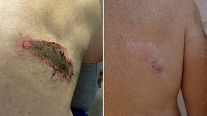 Comparativa de la herida por la picadura de la avispa asiática hace dos años (izquierda, cedida por el equipo médico) y la cicatriz actual en el paciente (derecha) en una fotografía de Rocío Badiola.