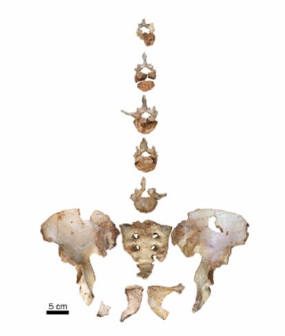 La pelvis y cinco vértebras lumbares de un individuo preneandertal de 45 años o más con malformaciones