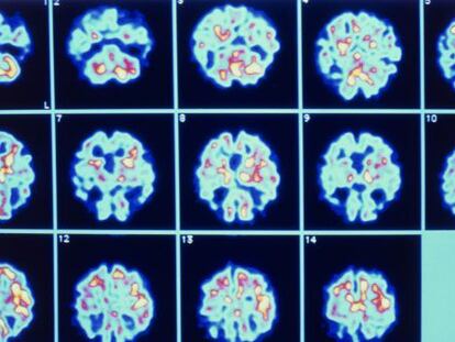 Deterioro de distintas partes del cerebro causado por el alzh&eacute;imer.