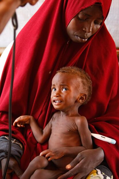 Un niño con síntomas de malnutrición llora mientras es examinado por un médico en una clínica gestionada por Médicos sin Fronteras (MSF) en el campamento Dagahaley, uno de los tres campamentos que forma parte del campo de refugiados de Dadaab, en el noreste de Kenia. MSF afirma que la tasa de malnutrición infantil entre los recién llegados a Dadaab se sitúa en el nueve por ciento, de los cuales un tres por ciento se encuentra en peligro de muerte. El campo de refugiados de Dadaab, el mayor complejo de este tipo existente en el mundo, se creó al inicio de la guerra civil en Somalia en 1991 con capacidad para 90.000 refugiados. Ahora está superpoblado con una llegada creciente de refugiados somalíes que huyen del conflicto.