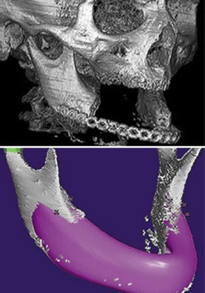 Imagen del cráneo sin el hueso y trasplante para la reconstrucción.