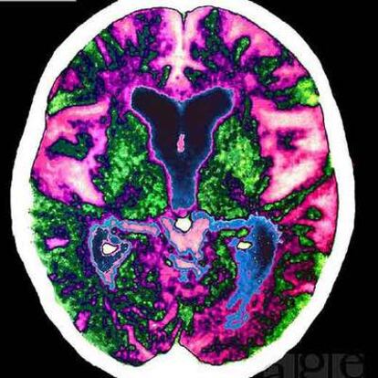 Imagen coloreada de un cerebro aquejado de alzheimer, obtenida por tomografía, en la que puede observarse el alcance de las lesiones.