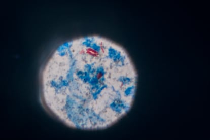 Bacteria 'Mycobacterium ulcerans', causante de la úlcera de Buruli, vista por el microscopio.