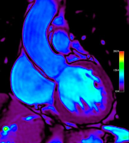 Escáner de resonancia magnética de un corazón humano realizado por el Doctor Richard Wellings.
