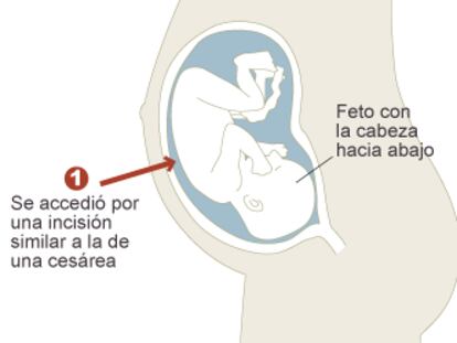 Un bebé con espina bífida podrá andar tras ser operado en el útero