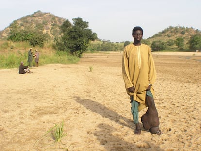 Un nigeriano afectado de filariasis linfática muestra su pierna, con los síntomas irreversibles de la elefantiasis. Los afectados 