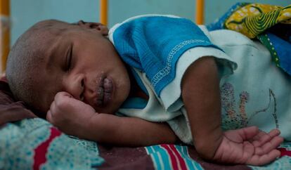 Issa, de dos semanas, fue alimentado con leche de cabra porque su madre murió en el parto y su familia no tenía otro alimento para él. Está ingresado en el hospital de Diffa.