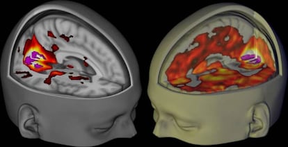 Representación en 3D de un cerebro bajo los efectos del LSD (derecha) y uno en estado normal.