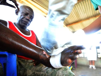 Un paciente de lepra es tratado en el  Hopital de la Rive de Kinshasa, en la República Democrática de Congo.  