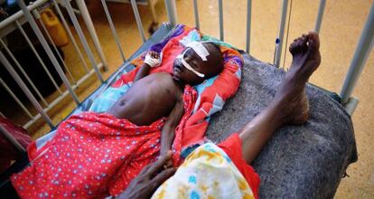 Un beb&eacute; malnutrido en un hospital de Mogadiscio.