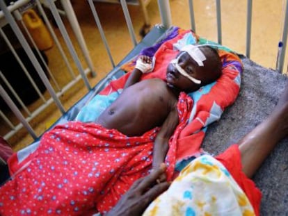 Un bebé malnutrido en un hospital de Mogadiscio.
