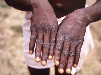 Lesiones provocadas por la viruela símica en un paciente en la República Democrática del Congo durante la etapa de recuperación de la enfermedad.