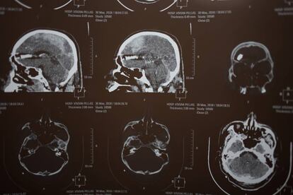 Radiografia de Jonathan Morazán após o disparo que o matou.