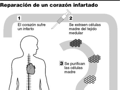 Reparación de un corazón infartado