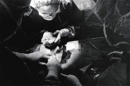 Una operación de cesárea.