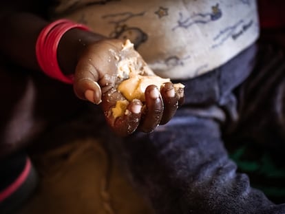Adama, de un año, se ha ensuciado las manos con pasta de cacahuete, un preparado terapéutico para tratar la desnutrición infantil.