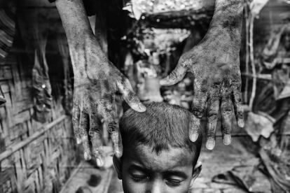 <p>Un niño rohingya en el campo de refugiados de Leda, en Bangladesh, donde ha encontrado refugio esta minoría musulmana procedente de Birmania. La mayoría de los habitantes de estos campamentos son niños.</p> <p>Los refugiados cuentan que su situación en estos lugares es extremadamente difícil. Las raciones de comida son más pequeñas de lo que dicen las autoridades. En vez de seis kilos de arroz, aseguran que les dan cinco. Las raciones de comida y las cartillas (llamadas libro de familia) se han convertido en una forma de protección contra las deudas. Muchos niños sufren malnutrición. La atención médica es muy deficiente o inexistente.</p> <p>Un solicitante de asilo afgano en la frontera entre Serbia y Hungría (2015) muestra sus manos infectadas mientras espera que llegue una ambulancia a la vieja fábrica de ladrillos abandonada de Subotica. El edificio se ha convertido en un refugio temporal para las personas de paso en su viaje hacia la Unión Europea.</p> <p>Los refugiados y los emigrantes han recorrido un camino lleno de dificultades y peligros para llegar a las fronteras europeas. Están cansados, a menudo heridos, y han contraído infecciones debido a la falta de asistencia médica. Con frecuencia han sido víctimas de malos tratos.</p>