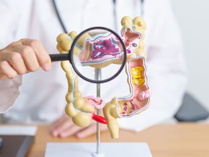La enfermedad inflamatoria intestinal, que engloba tanto la enfermedad de Crohn como la colitis ulcerosa, afecta a un 1% de la población y suele diagnosticarse entre los 15 y los 30 años.