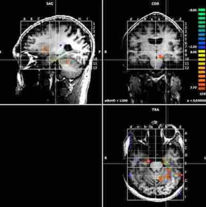 La resonancia magnética nuclear muestran la activación en la zona entorrinal.