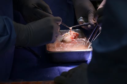 The genetically modified kidney before being transplanted, in the operating room.