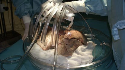 A lung transplant at a Madrid hospital.