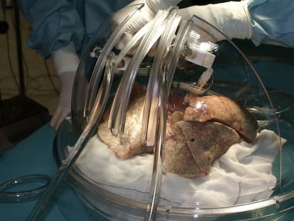 A lung transplant at a Madrid hospital.