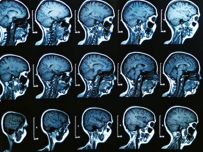 Resonancia magnética de un cerebro humano.