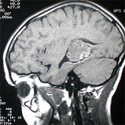 Resonancia magnética que muestra un angioma en el lóbulo temporal del cerebro.