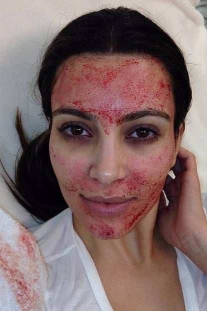Kim Kardashian es uno de los máximos exponentes a la hora de presumir lo mucho que sufre para estar bella. Aquí, un escalofriante selfie en pleno Vampire Lift